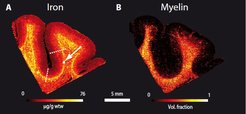 The team created very high resolution maps of the white-grey matter border across the entire living brain.